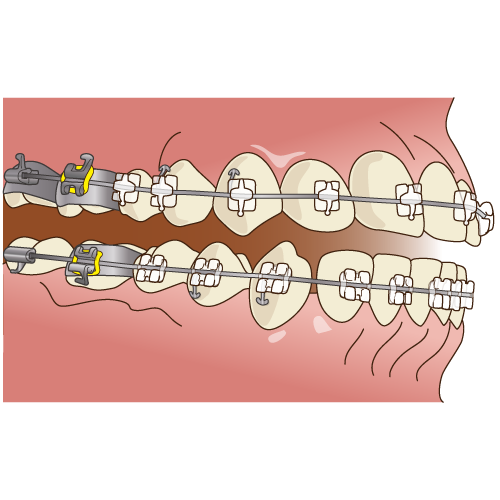 デーモンシステム（表側矯正・唇側矯正）