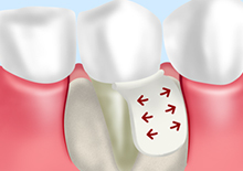 GTR法（歯周組織再生療法）